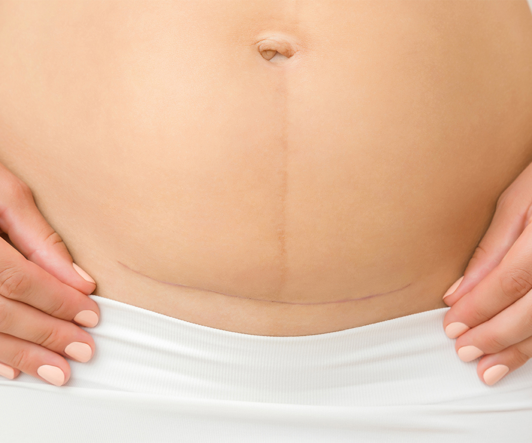 Section Scarring Physical Terapy